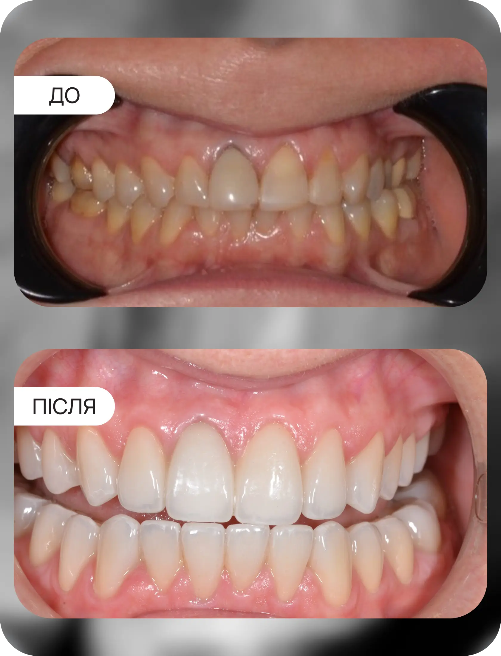 тотальна робота коронки EMAX