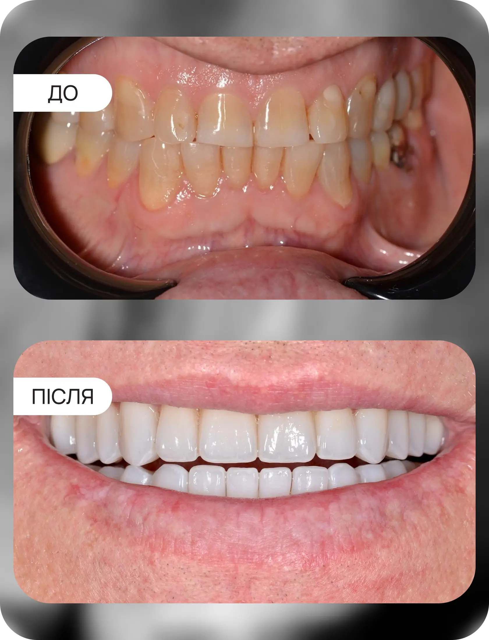вініри на верхній та нижній зубний ряд