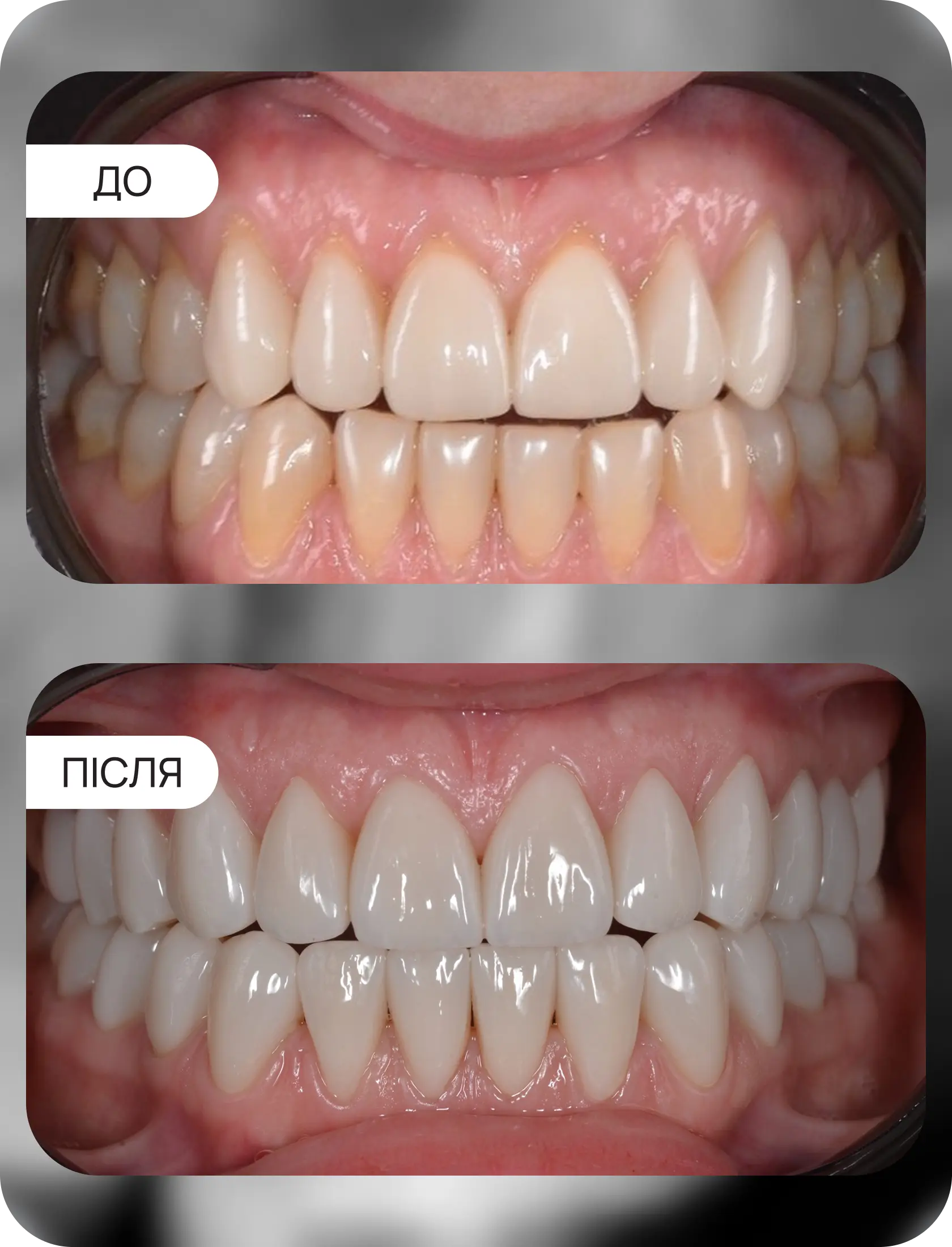 тотальна робота коронки EMAX