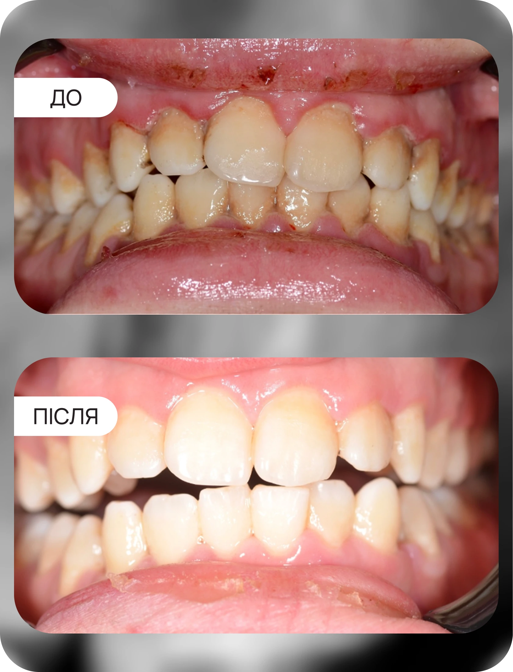 професійнЕ чищення зубних відкладень