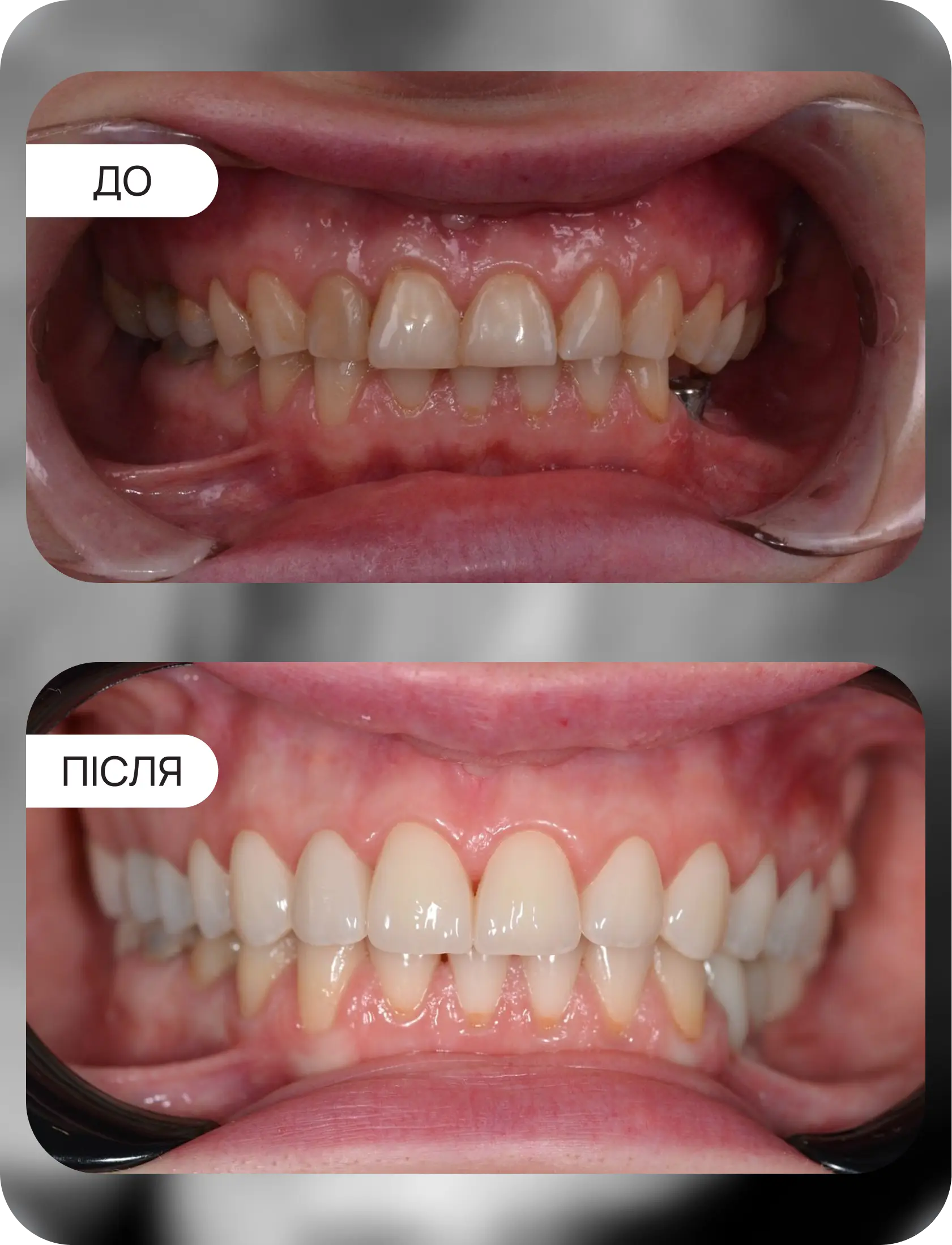 цирконієві коронки